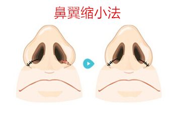 鼻翼整形方法之一鼻翼縮小法