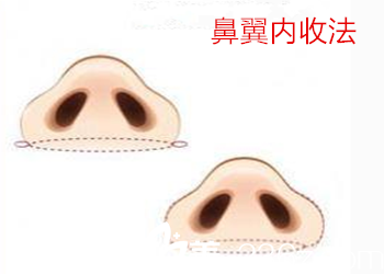 鼻翼整形之一鼻翼內(nèi)收法