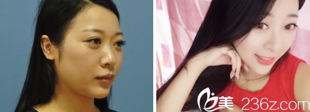 艾長安醫(yī)生的鼻綜合整形<span style= 艾長安醫(yī)生的鼻綜合整形<span style=