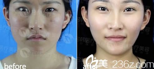 李陽雙眼皮案例圖 李陽雙眼皮案例圖