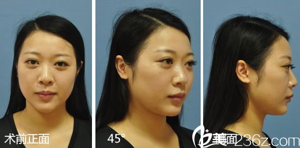 做鼻綜合整形手術前的鼻子 做鼻綜合整形手術前的鼻子