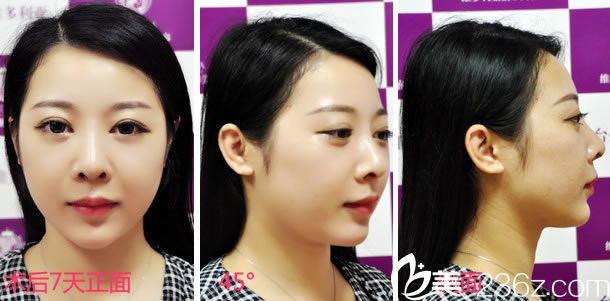 做鼻綜合手術7天正側面效果 做鼻綜合手術7天正側面效果