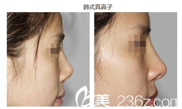 湛美院長朱本谷隆鼻案例 湛美院長朱本谷隆鼻案例