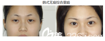 湛美院長朱本谷雙眼皮案例