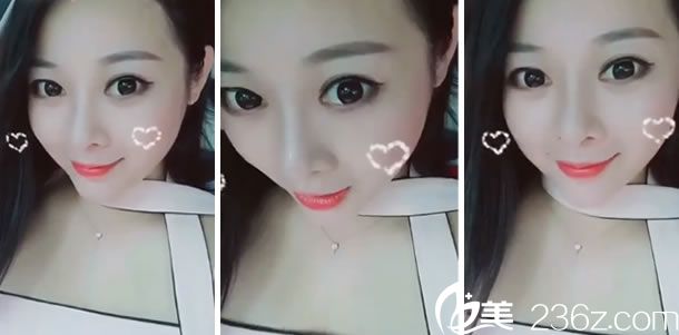 隆鼻手術第12天的效果圖片 隆鼻手術第12天的效果圖片