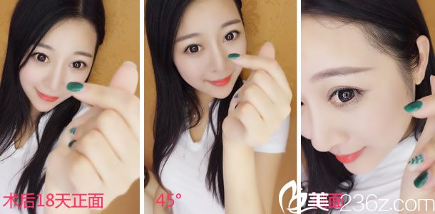 塌鼻子做手術第18天的效果 塌鼻子做手術第18天的效果