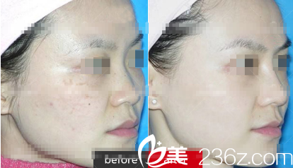 朗睿醫(yī)學(xué)祛斑案例