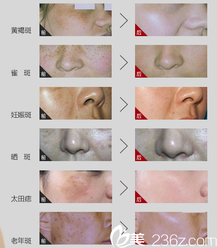 湛美何慧霞祛斑案例 湛美何慧霞祛斑案例