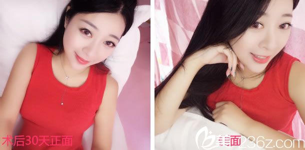 做鼻綜合整形手術1個月照片 做鼻綜合整形手術1個月照片