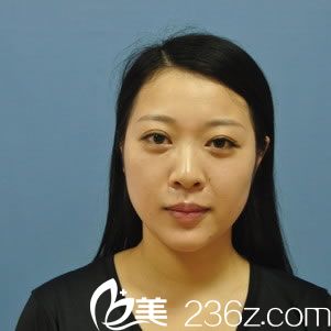 臺州維多利亞醫(yī)療美容醫(yī)院艾長安術前照片1