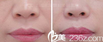 法令紋注射填充案例