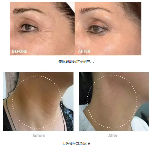 黃蓉醫(yī)生除皺案例 黃蓉醫(yī)生除皺案例