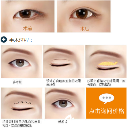 張文琪醫(yī)生精雕無痕雙眼皮 張文琪醫(yī)生精雕無痕雙眼皮