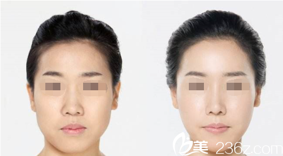 韓國will醫(yī)院魏亨坤院長玻尿酸隆鼻案例