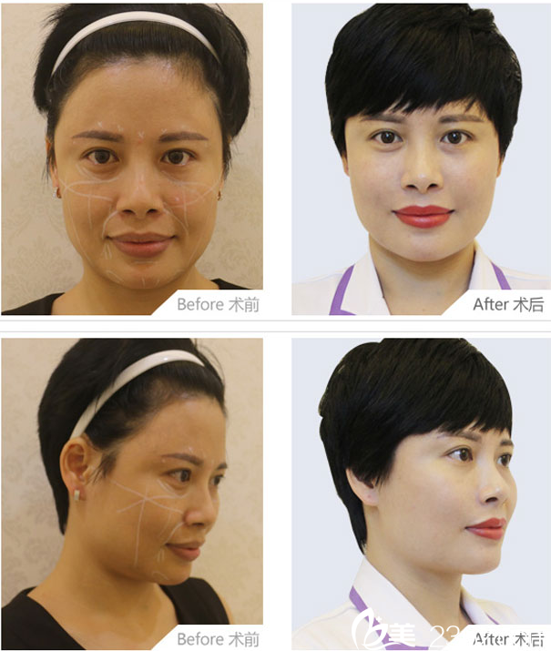劉真俊面部年輕化注射案例 劉真俊面部年輕化注射案例