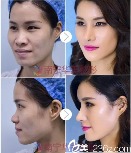 南寧華美盧志剛隆鼻案例 南寧華美盧志剛隆鼻案例