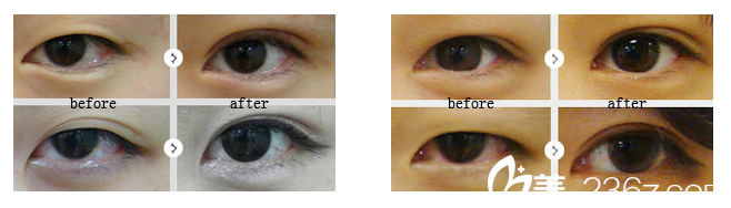 南寧華美盧志剛雙眼皮案例 南寧華美盧志剛雙眼皮案例