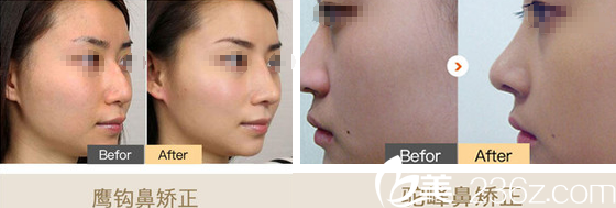 鼻整形案例對比圖 鼻整形案例對比圖