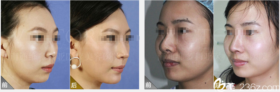 南通維多利亞進(jìn)口艷冠隆鼻假體優(yōu)惠價(jià)1800元