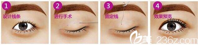 石家莊巍名仕韓式三點(diǎn)微創(chuàng)雙眼皮現(xiàn)價(jià)2780元