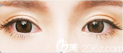 北京米蘭柏羽麗都整形美容醫(yī)院雙眼皮示意圖