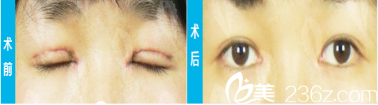 北京米蘭柏羽麗都整形美容醫(yī)院案例