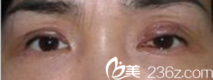 雙眼皮失敗雙眼皮修復(fù)