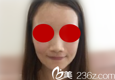 求美者去will醫(yī)院做鼻綜合前的照片