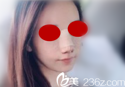 在will醫(yī)院做鼻綜合術(shù)天