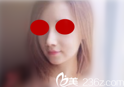 在will醫(yī)院做鼻綜合手術(shù)后一周