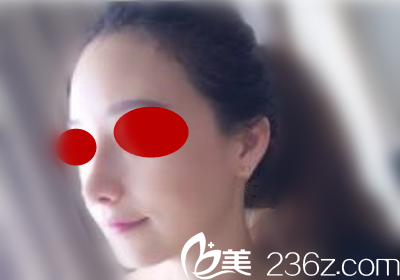 去韓國做鼻綜合術(shù)后半個月回國