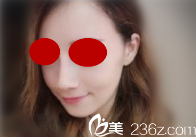 做鼻綜合手術(shù)后一個月