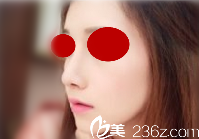 做鼻綜合50天后鼻子已經(jīng)定型