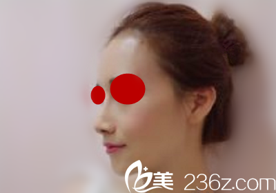 做鼻綜合后側(cè)顏照