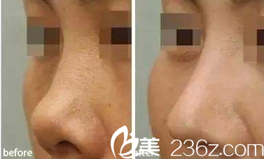 太原華美<!--<i data=20240703-sp></i>-->鼻綜合案例 太原華美<!--<i data=20240703-sp></i>-->鼻綜合案例