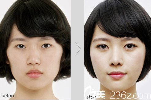 濟(jì)南瑞麗醫(yī)院雙眼皮加開(kāi)眼角特價(jià)3999元