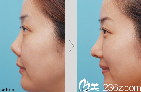 濟(jì)南瑞麗醫(yī)院假體隆鼻加耳軟骨墊鼻尖爆款特價(jià)4999元