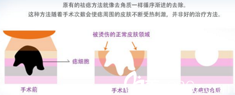 激光祛痣示意圖