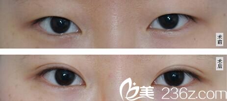 雙眼皮案例 雙眼皮案例