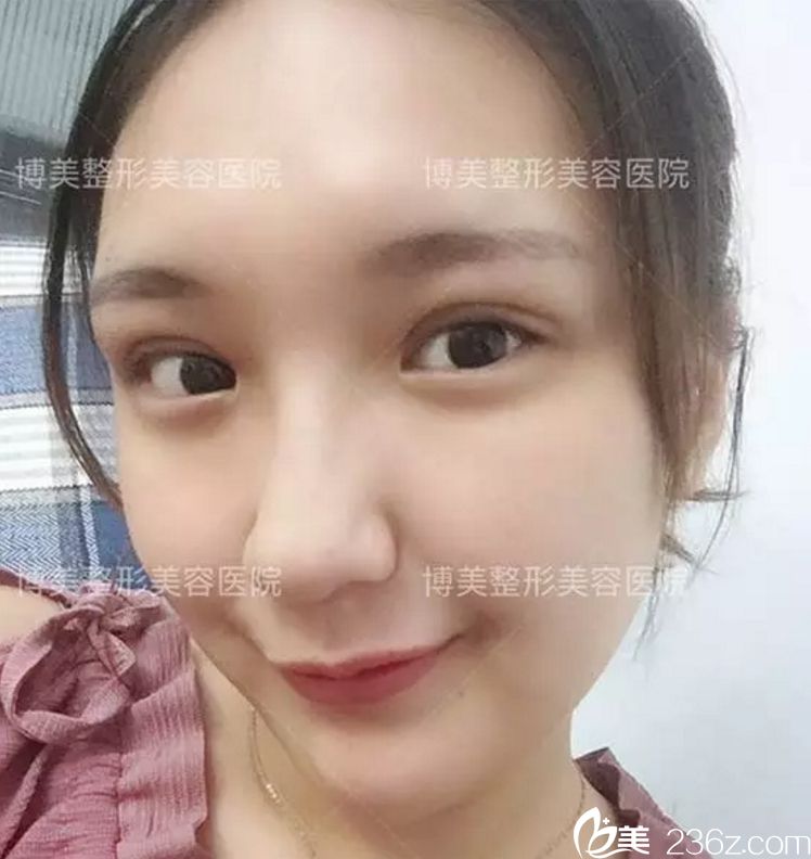 永州博美整形怎么樣？永州博美整形做雙眼皮怎么樣？