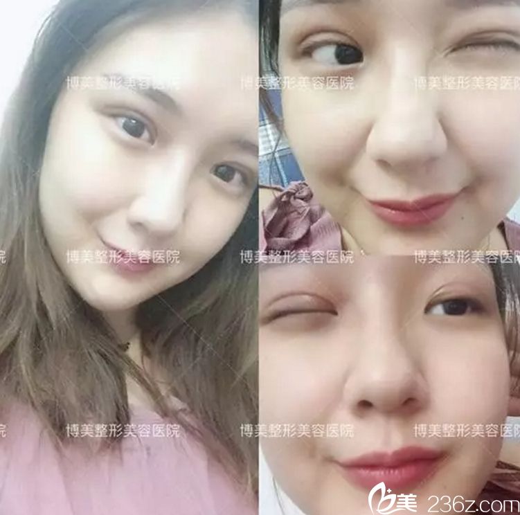 永州博美做雙眼皮8天后