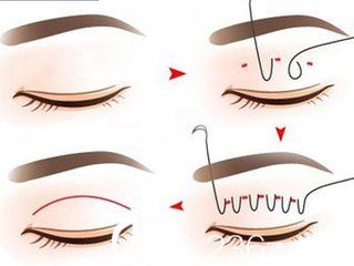 埋線雙眼皮的方法示意圖