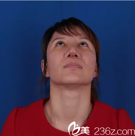 鼻修復(fù)術(shù)前抬頭照 鼻修復(fù)術(shù)前抬頭照