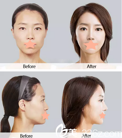 李信奎韓式真鼻子案例對(duì)比 李信奎韓式真鼻子案例對(duì)比