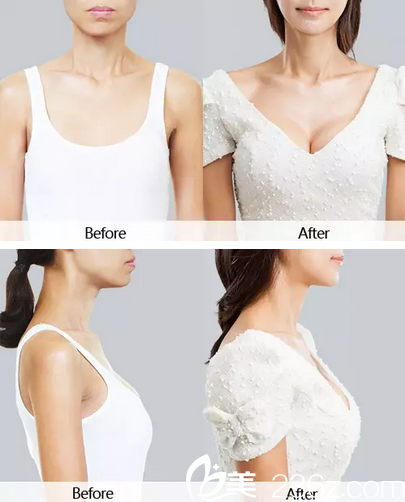 李信奎韓式無(wú)痕四維豐胸對(duì)比圖 李信奎韓式無(wú)痕四維豐胸對(duì)比圖