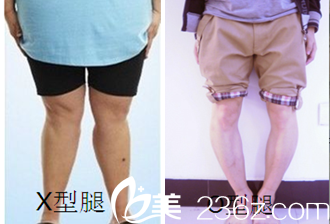 韓國(guó)365mc醫(yī)院x型腿o型腿不良腿型矯正