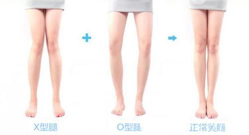 不良腿型矯正—韓國(guó)365mc醫(yī)院矯正腿型