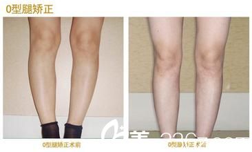 吸脂矯正o型腿——韓國(guó)365mc醫(yī)院