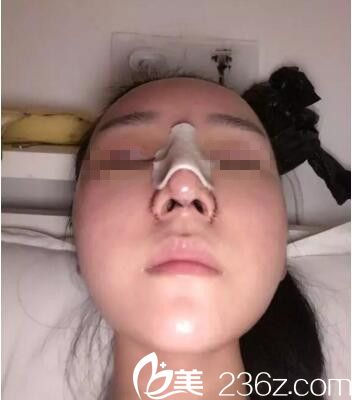 術(shù)后三天效果