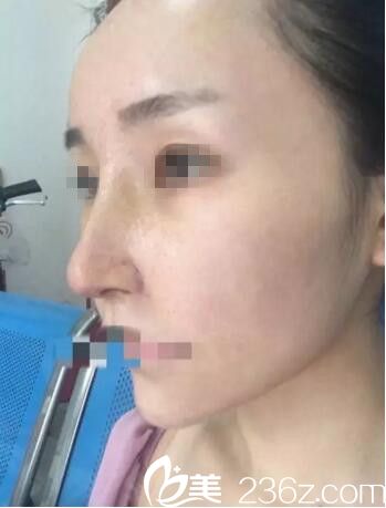 術(shù)后7前拆線效果